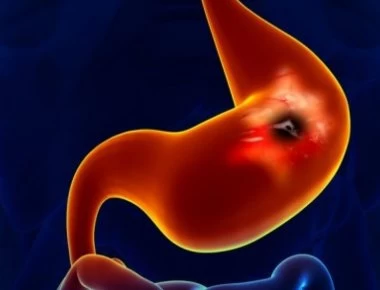 Έλκος στομάχου: Τι είναι ακριβώς, συμπτώματα και σωστή αντιμετώπιση